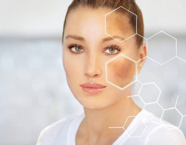 tratamiento contra melasma