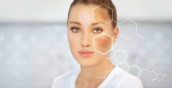 tratamiento contra melasma