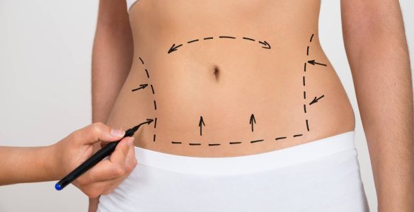 eliminar celulitis en abdomen