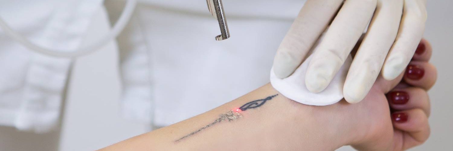 laser para eliminar tatuajes