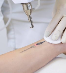 laser para eliminar tatuajes