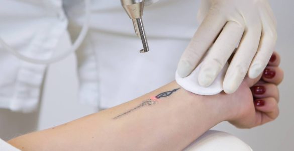 laser para eliminar tatuajes