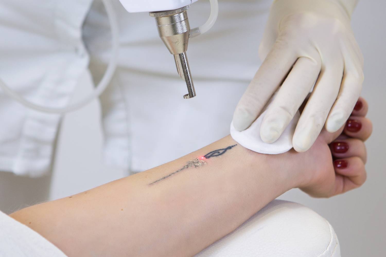 ▷ 5 preguntas sobre eliminación de tatuajes con láser