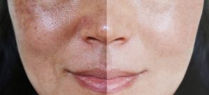 Melasma: todo lo que debes saber