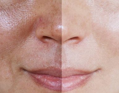 Melasma: todo lo que debes saber