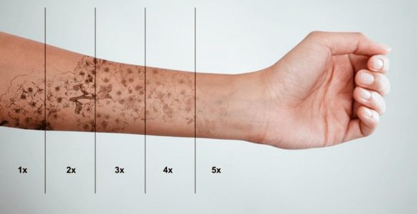 borrar tatuaje de forma natural