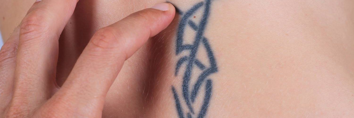 quitar tatuaje quirurgicamente