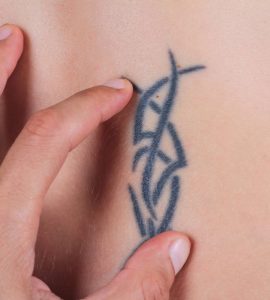 quitar tatuaje quirurgicamente