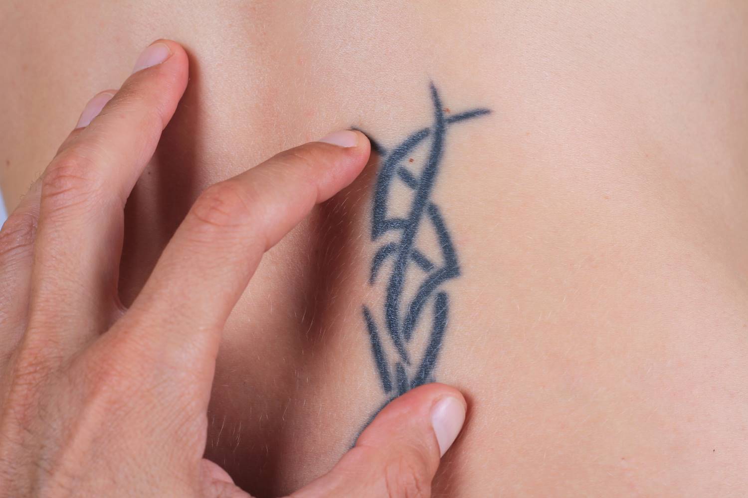 ▷ La eliminación de un tatuaje quirúrgicamente