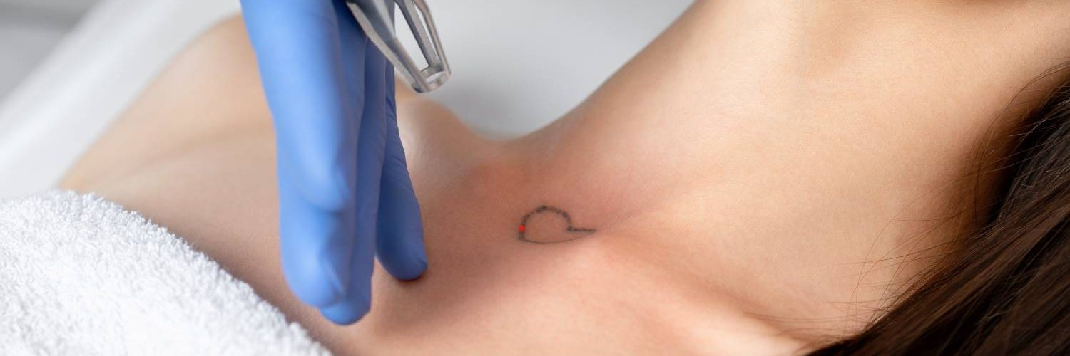 eliminar tatuaje una sesion