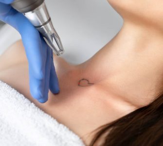 eliminar tatuaje una sesion