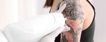 eliminación-tatuajes-láser-IML