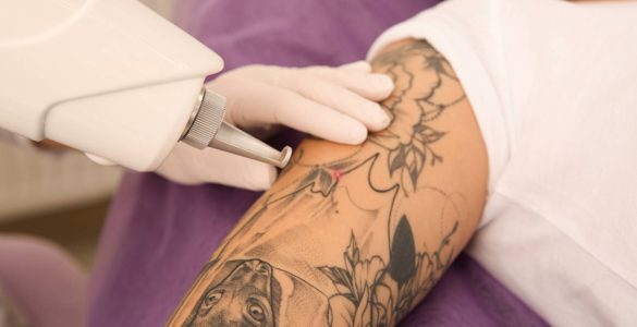 quitar tatuaje en verano