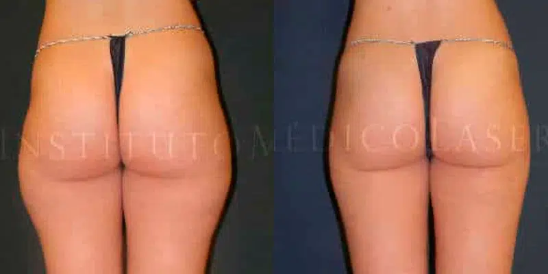 Antes y después de eliminar cartucheras
