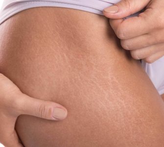 combatir flacidez piernas