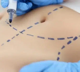operacion de abdominales