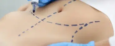 operacion de abdominales