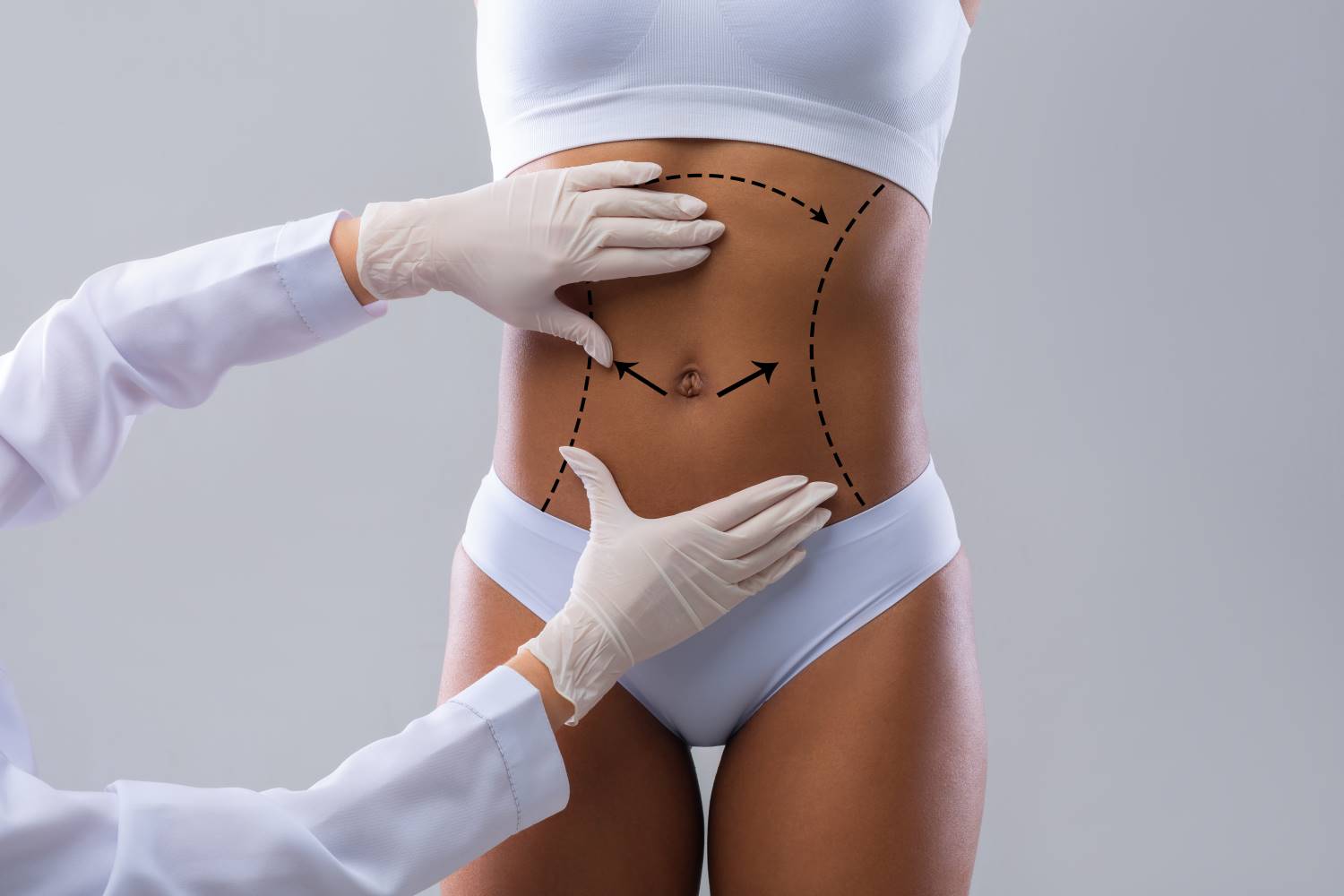 ▷ ¿Cuáles son las cirugías abdominales más frecuentes?