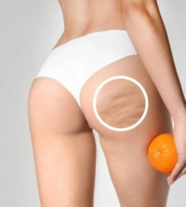 combatir piel de naranja