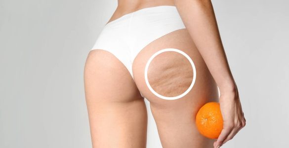 combatir piel de naranja