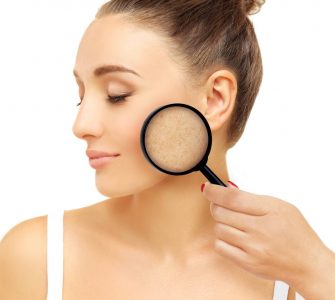 como actuar contra melasma