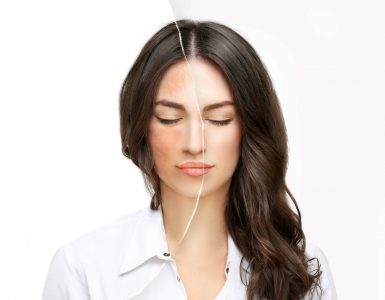 como prevenir melasma