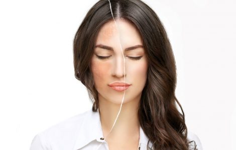 como prevenir melasma