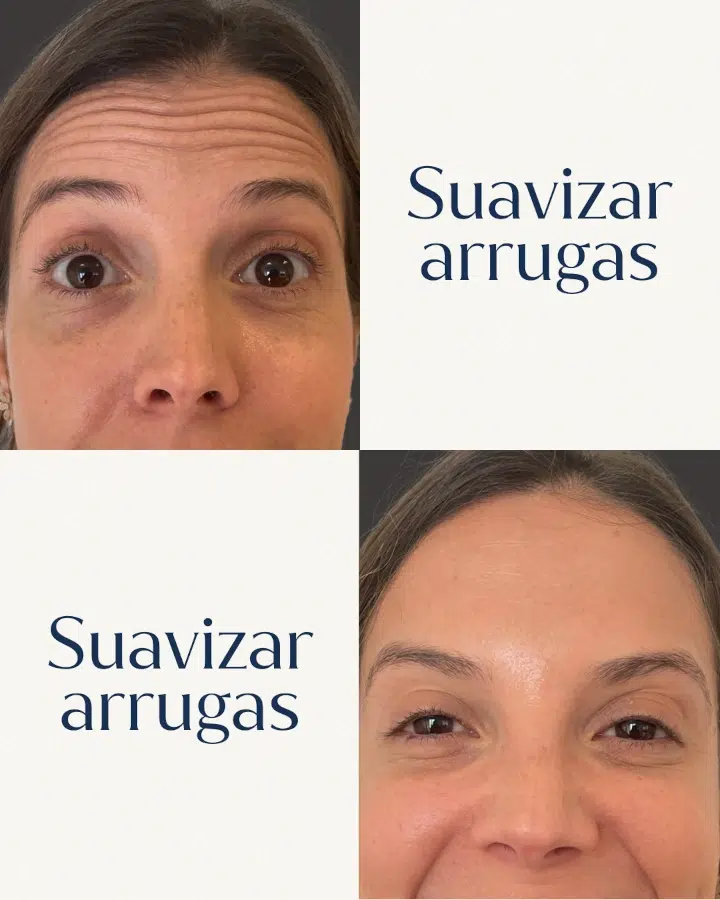 Antes y después de suavizar arrugas