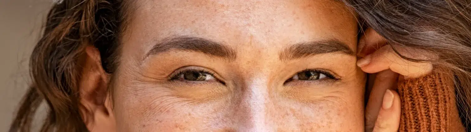 Patas de gallo en jóvenes