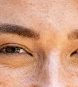 Patas de gallo en jóvenes