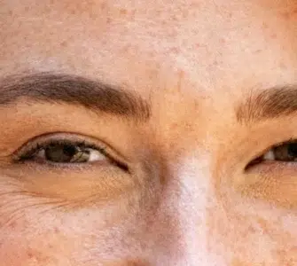 Patas de gallo en jóvenes