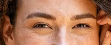 Patas de gallo en jóvenes