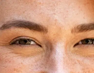 Patas de gallo en jóvenes