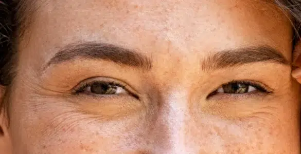 Patas de gallo en jóvenes