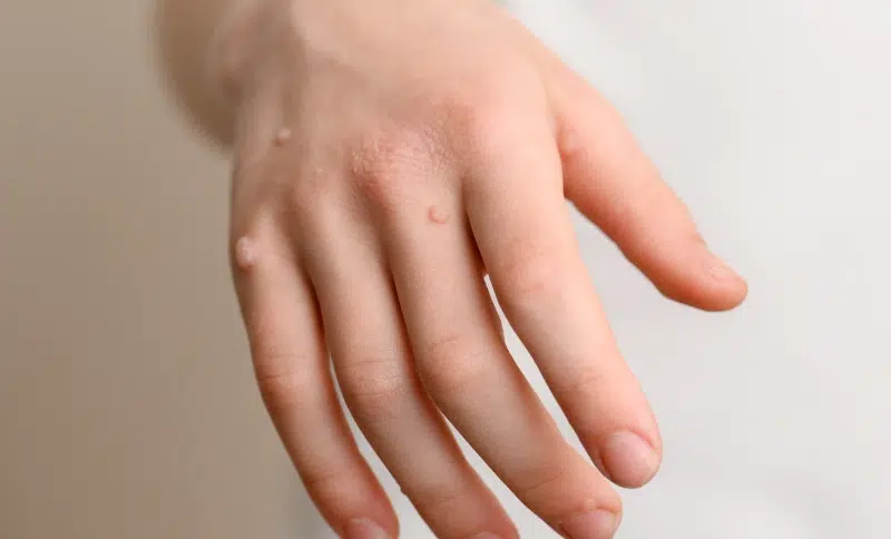 Foto verruga vulgar en manos