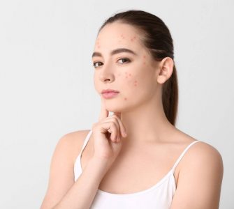 cicatrices acne
