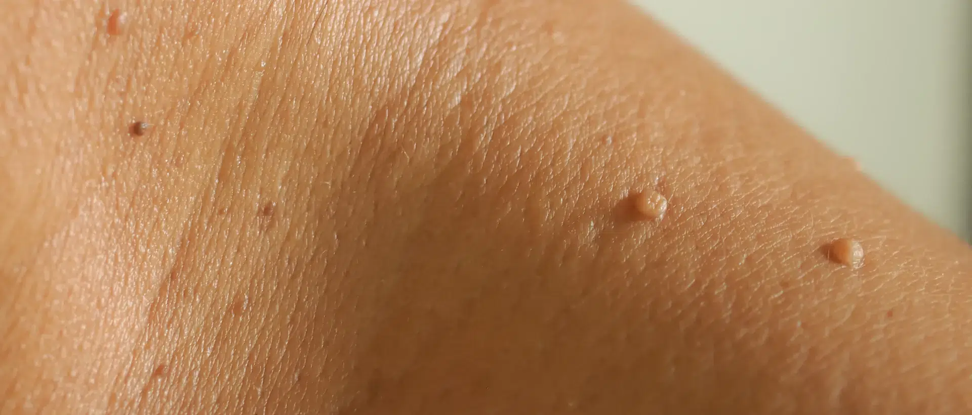 Tipos de verrugas y cómo tratarlas