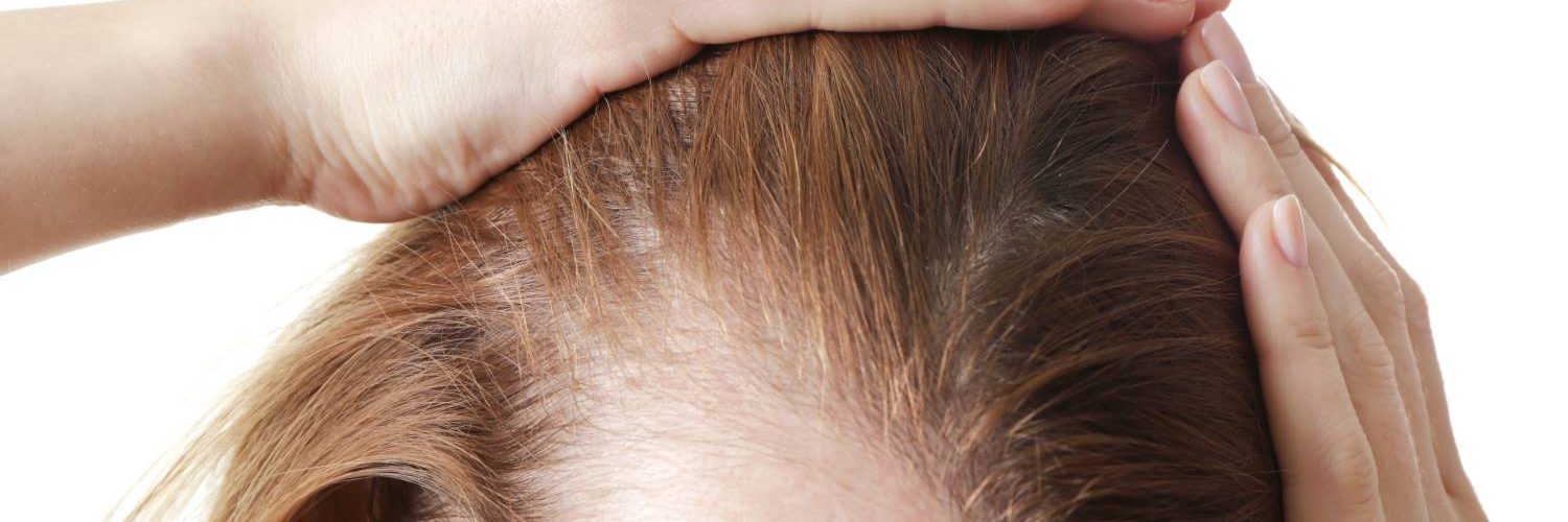 tipos de alopecia femenina