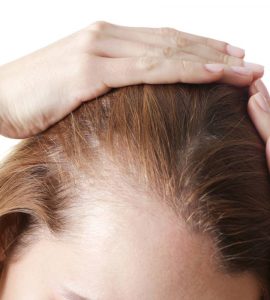 tipos de alopecia femenina