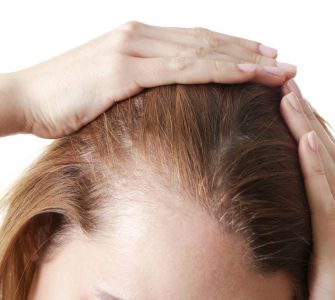 tipos de alopecia femenina