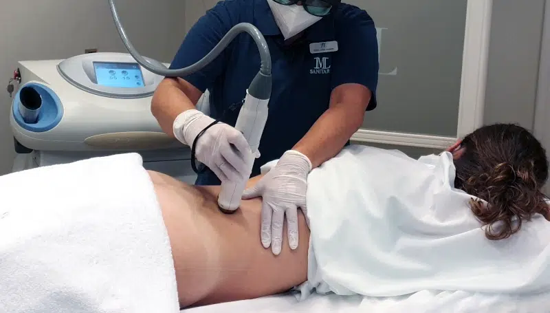 Tratamiento para eliminar estrías con láser en IML Clinic Madrid