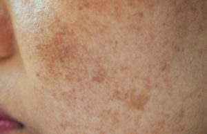 melasma