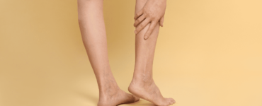 Venaseal, el tratamiento para eliminar varices