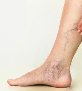 tratamiento venas varices