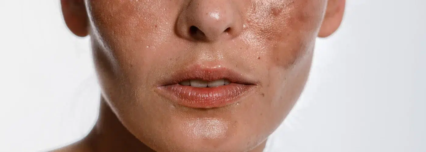 Melasma y manchas