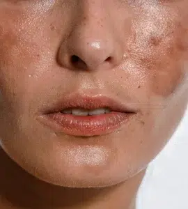 Melasma y manchas