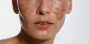 Melasma y manchas