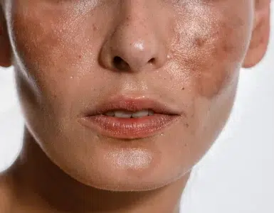 Melasma y manchas