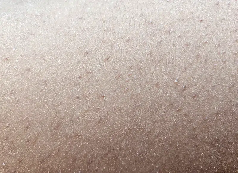 Aspecto de la queratosis pilaris en glúteos