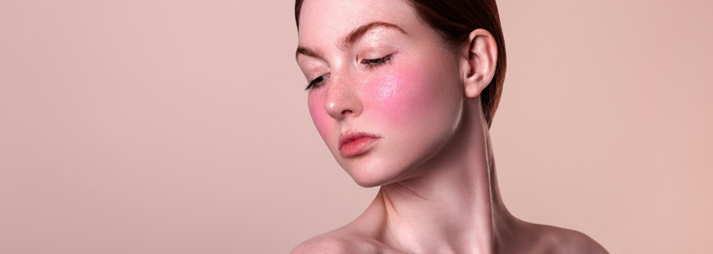 cuperosis y rosacea